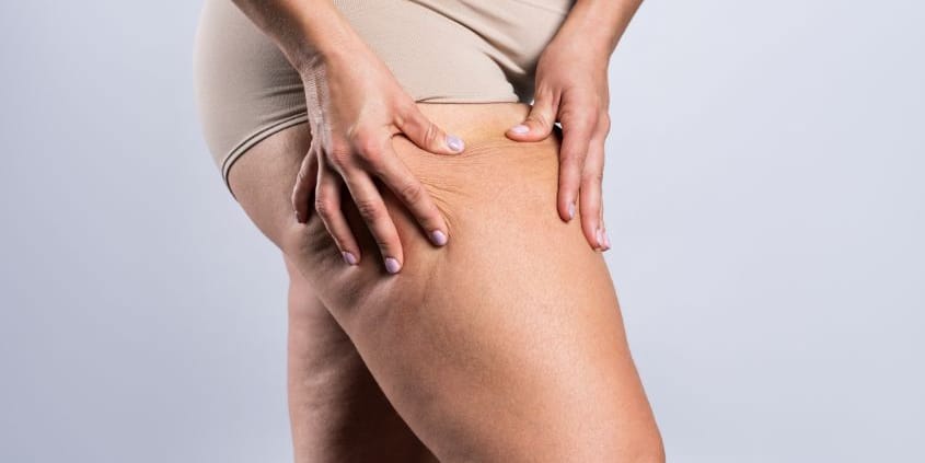 Lipödem erkennen: Häufige Symptome und deren Ursachen