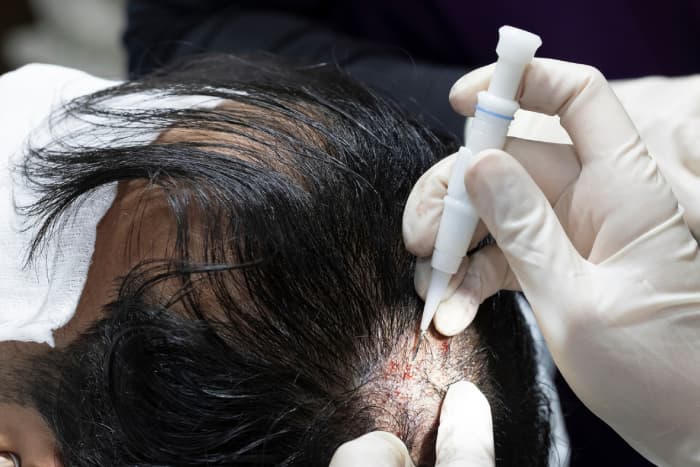 Haartransplantation istanbul für Frauen: Eine Lösung für dünner werdendes Haar