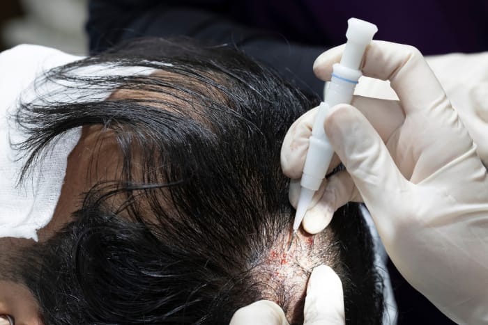 Haartransplantation istanbul für Frauen: Eine Lösung für dünner werdendes Haar